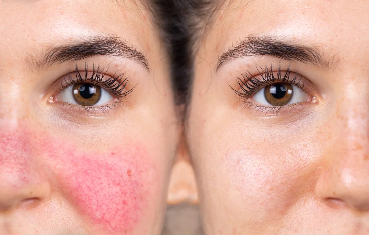 Laserbehandlung beim Hautarzt Rostock, Gesichtsrötung und Couperose vor und nach der dermatologischen Behandlung
