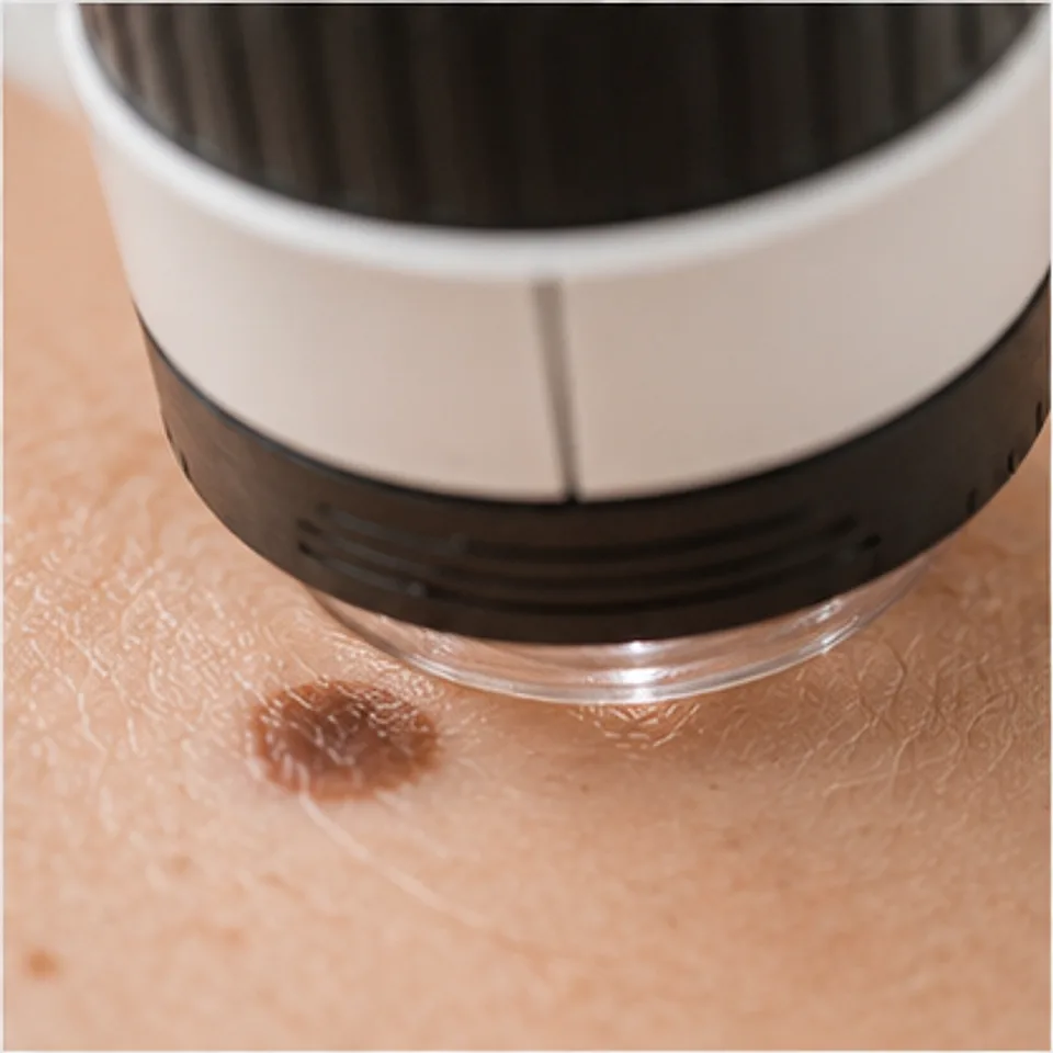 Hautkrebsarten erkennen in Rostock: Dermatoskop über einem Muttermal beim Hautkrebsscreening